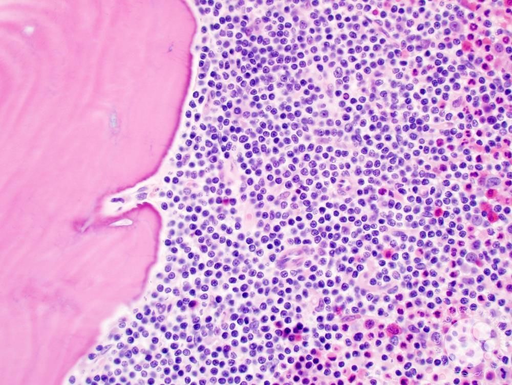 Blood Cancer: Australia’s silent women’s health crisis